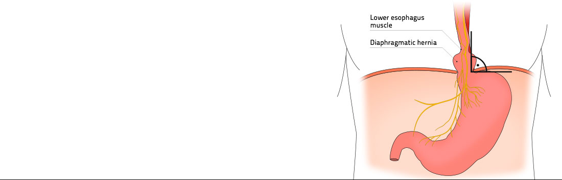 Illustration of a typical diaphragmatic hernia